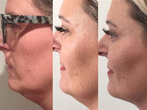 Belkyra chin injection in Australia: The way to melt .